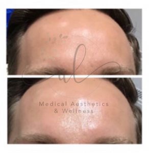 Anti-wrinkle injections before and after