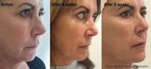 Before and after Profhilo Treatment